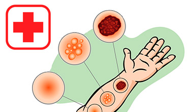 Significado de Primeiros socorros (O que são, Conceito e Definição